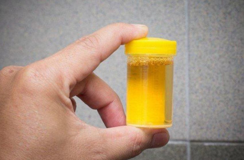  Kenali Ciri Urine yang Normal Berdasarkan Warnanya