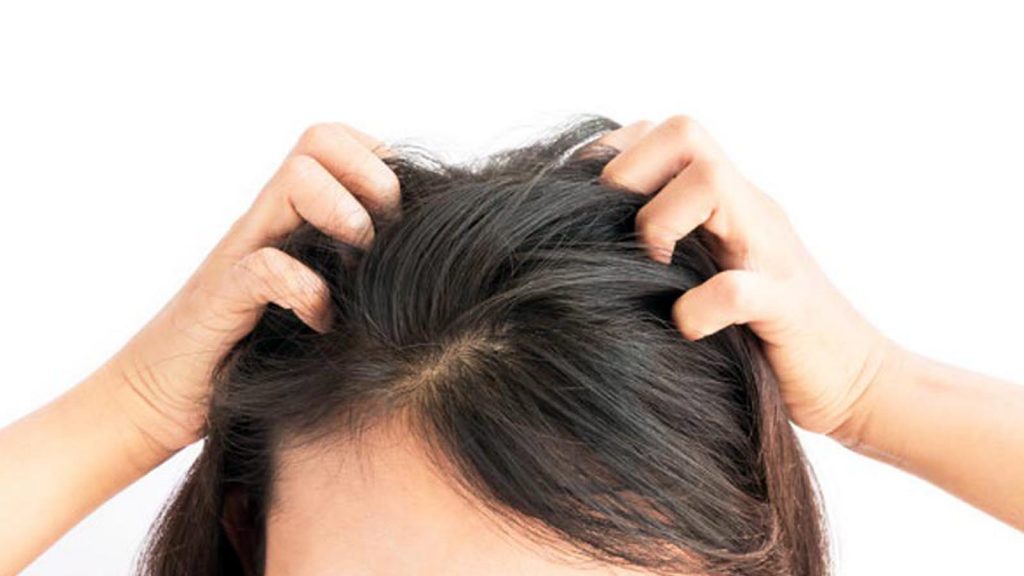 Bukan Cuma Ketombe, Ini Penyakit Kulit Kepala yang Perlu Diketahui