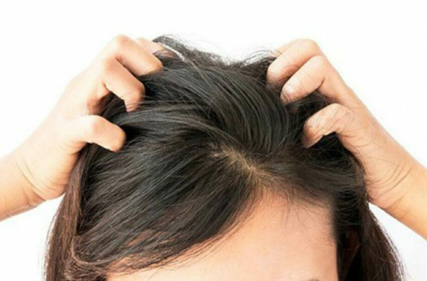  Tips Menghilangkan Kutu Rambut Secara Efektif