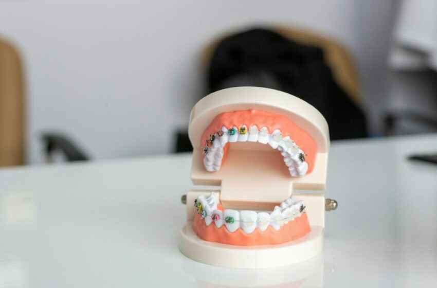  Menghadapi Proses Pemasangan Kawat Gigi, Kondisi yang Dialami dan Cara Mengatasinya