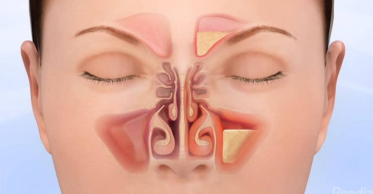  Bahaya Sinusitis Kronis: Lebih dari Sekedar Hidung Tersumbat